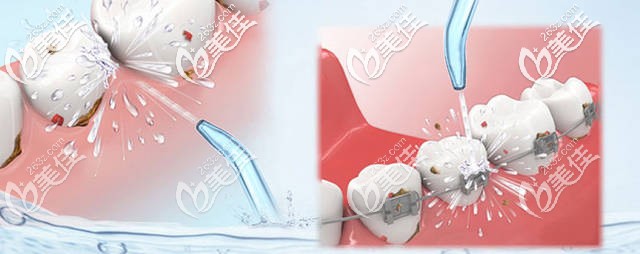 洗牙圖示 洗牙圖示