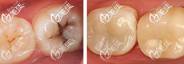 樹脂補牙前后效果圖