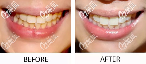 皓齒美白是冷光美白的升級版！