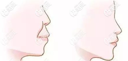 深覆合矯正前后臉型變化