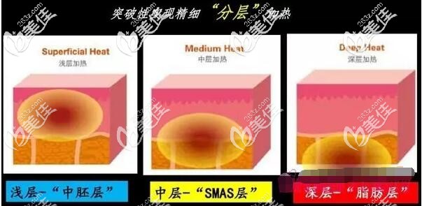 劉光醫(yī)生分享熱拉提的作用原理