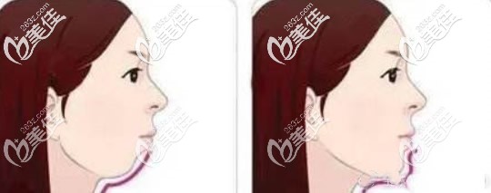 側(cè)臉沒有下頜線怎么辦