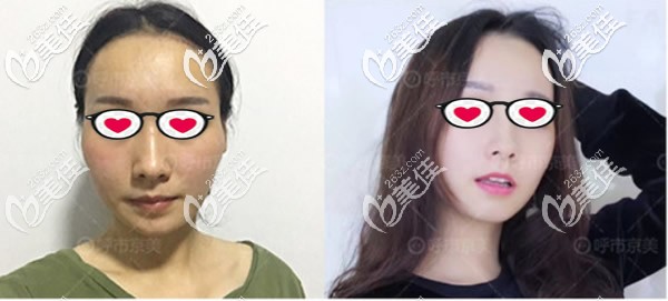 面部脂肪膠填充+埋線(xiàn)提升后醫(yī)生讓我?guī)ь^套,會(huì)不會(huì)把移植的脂肪壓死呀?