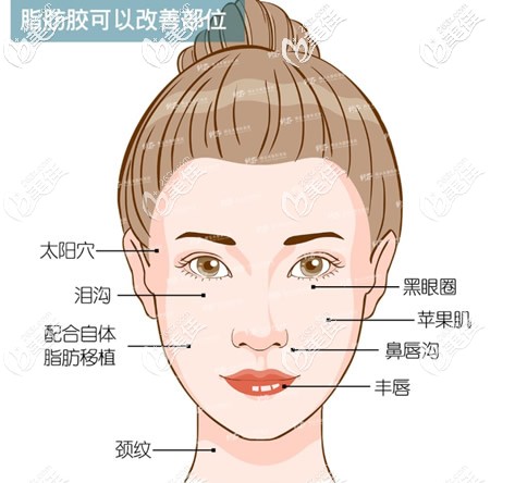 脂肪膠可以改善哪些部位