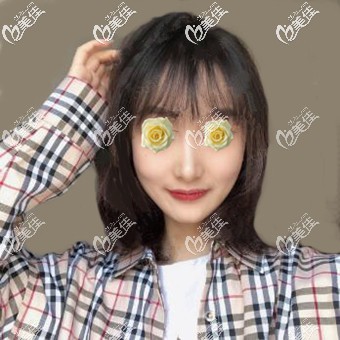 玻尿酸隆下巴術(shù)后35天恢復(fù)照