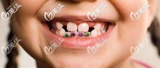 千萬別給小孩矯正牙齒 千萬別給小孩矯正牙齒