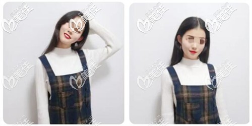 方臉真的就要靠磨骨嘛?用我下頜骨截骨真實(shí)感受給你說說為什么建議切下頜角