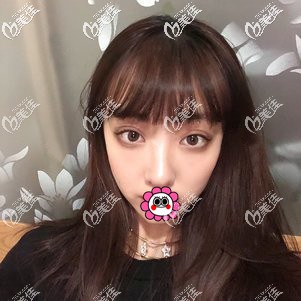 溫州芘麗芙雙眼皮恢復(fù)一個(gè)月效果