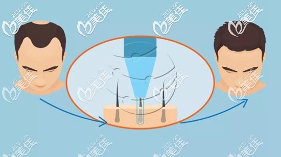 毛發(fā)移植手術(shù)的原理過程