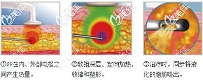 黃金微雕瘦臉的原理