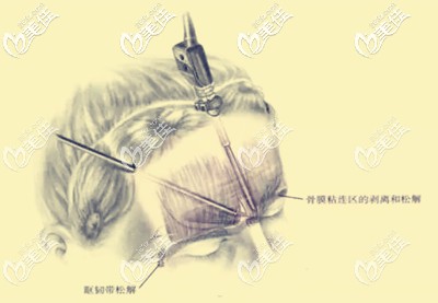 內(nèi)窺鏡面部提升手術(shù)的優(yōu)勢(shì) 內(nèi)窺鏡面部提升手術(shù)的優(yōu)勢(shì)