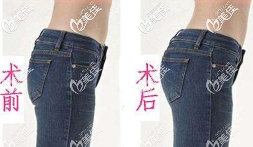 臀部抽脂手術(shù)前后照片
