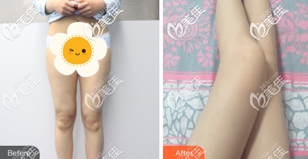 大腿吸脂前后對(duì)比照片 大腿吸脂前后對(duì)比照片