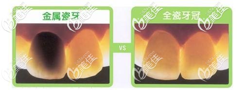 烤瓷牙和全瓷牙區(qū)別圖 烤瓷牙和全瓷牙區(qū)別圖