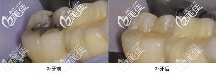 補(bǔ)牙前后對(duì)比圖 補(bǔ)牙前后對(duì)比圖