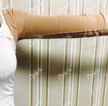 蘭州時(shí)光胳膊吸脂7天恢復(fù)圖
