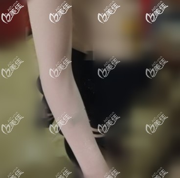 在蘭州時(shí)光手臂吸脂后內(nèi)側(cè)有拉扯感,恢復(fù)期好痛苦呀,但3個(gè)月后胳膊瘦了蝴蝶袖也消失了!