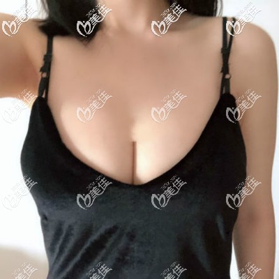 寶儷假體250cc隆胸三個月療效圖片