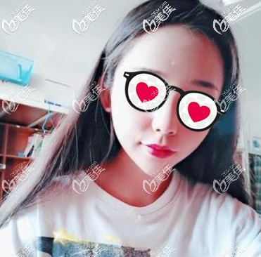 我面部脂肪填充一年后臉凹陷了,皮膚更松弛了!醫(yī)生建議用全臉埋線提升或熱瑪吉來修復!