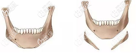 長(zhǎng)曲線(xiàn)下頜角手術(shù)效果 長(zhǎng)曲線(xiàn)下頜角手術(shù)效果