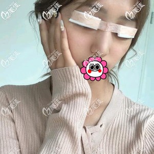 雙眼皮術(shù)后即刻