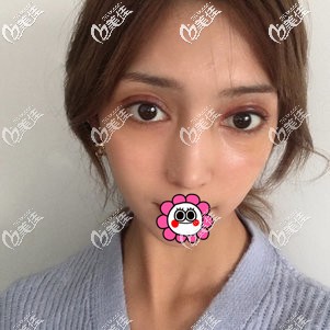 7天拆線后雙眼皮有淤青腫脹