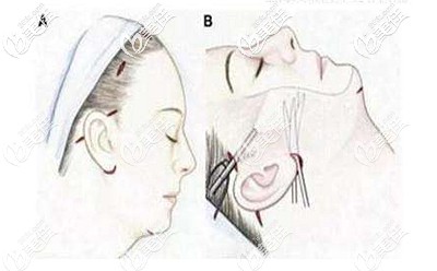 筋膜懸吊手術(shù)的原理