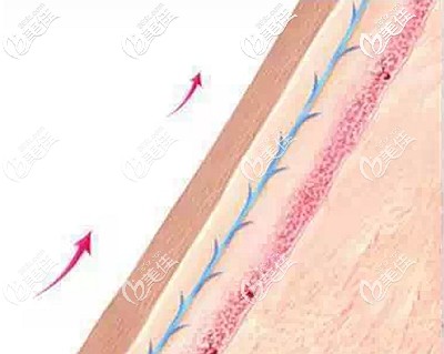面部埋線提升的優(yōu)勢(shì)