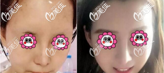 快來看看西安高一生要價10000多的面部自體脂肪填充案例再決定吧