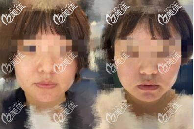 我做第四代熱瑪吉治療一個(gè)月效果圖片 我做第四代熱瑪吉治療一個(gè)月效果圖片