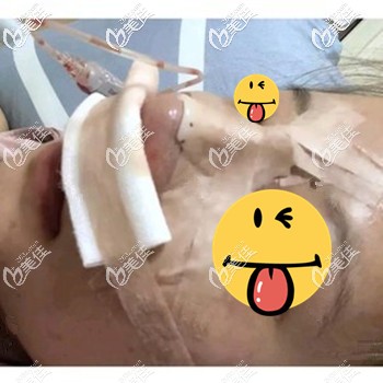 做完隆鼻手術(shù)當(dāng)天鼻子不通氣