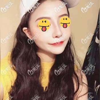 做完肋骨鼻因為腫脹鼻梁會感覺有點高