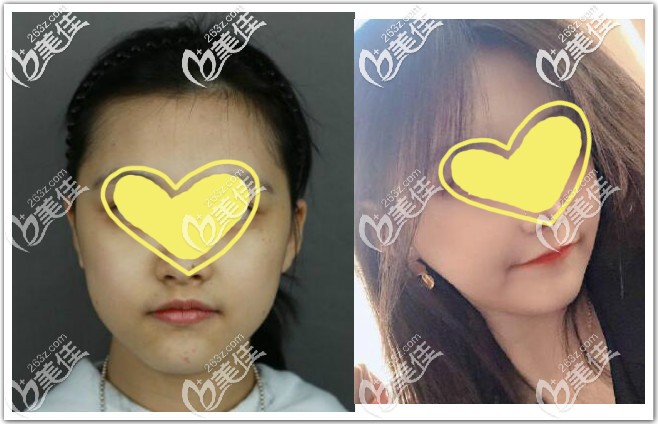 顴骨內(nèi)推+下頜骨截骨手術恢復6個月效果圖 顴骨內(nèi)推+下頜骨截骨手術恢復6個月效果圖