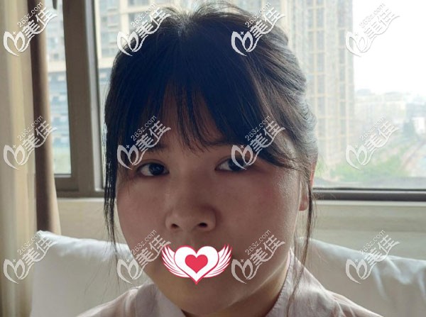 面部吸脂手術前 面部吸脂手術前