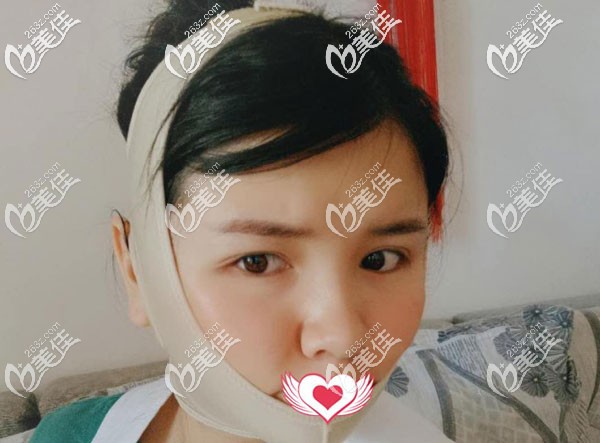 臉部吸脂第二天臉腫的厲害 臉部吸脂第二天臉腫的厲害