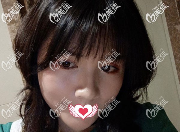 面部吸脂術后40天臉頰的脂肪已經(jīng)掉下來了 面部吸脂術后40天臉頰的脂肪已經(jīng)掉下來了