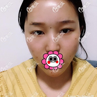 脂肪填充全臉第二天看起來有點(diǎn)腫 脂肪填充全臉第二天看起來有點(diǎn)腫