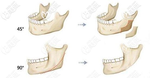 磨骨和削骨的區(qū)別