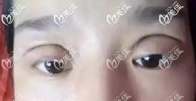 全切雙眼皮失敗照片 全切雙眼皮失敗照片