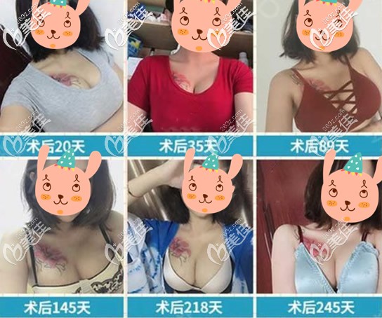 我自體脂肪豐胸三四年后乳房依然飽滿,隆胸的手感和真的一樣!