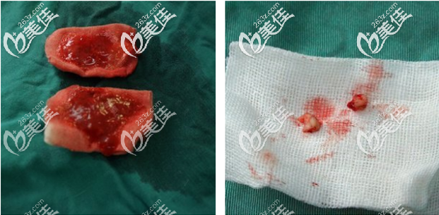 我在廣州荔灣區(qū)<!--<i data=20240703-sp></i>-->取的鼻子奧美定很干凈沒(méi)有后遺癥