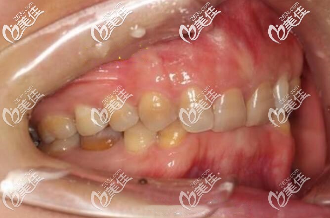 我的閉鎖性深覆合牙齒圖