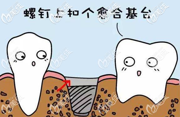 無需等待，當(dāng)天拔牙當(dāng)天種植