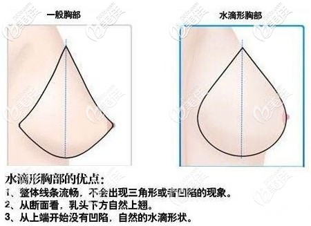 水滴型假體豐胸的效果 水滴型假體豐胸的效果