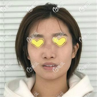 做美國舒鉑鼻術(shù)前照片