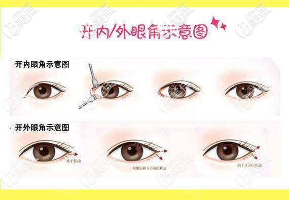開眼角有開內眼角和開外眼角之分