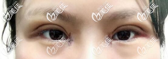 開眼角術后有很大幾率會留下疤痕