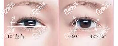 開眼角內外角度選擇