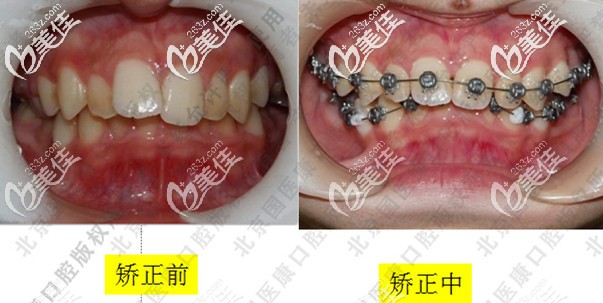 深覆合矯正前牙齒的照片 深覆合矯正前牙齒的照片