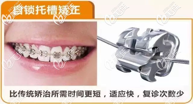 自鎖托槽矯正器的特點 自鎖托槽矯正器的特點